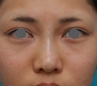 症例写真,ヒアルロン酸注射と耳介軟骨移植で鼻のバランスを整えた症例写真の術前術後画像,手術直後,mainpic_ryubichusha03b.jpg