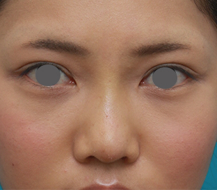 症例写真,ヒアルロン酸注射と耳介軟骨移植で鼻のバランスを整えた症例写真の術前術後画像,1週間後,mainpic_ryubichusha03d.jpg