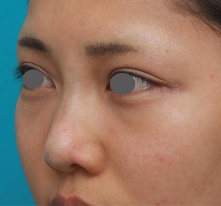 症例写真,ヒアルロン酸注射と耳介軟骨移植で鼻のバランスを整えた症例写真の術前術後画像,手術直後,mainpic_ryubichusha03g.jpg