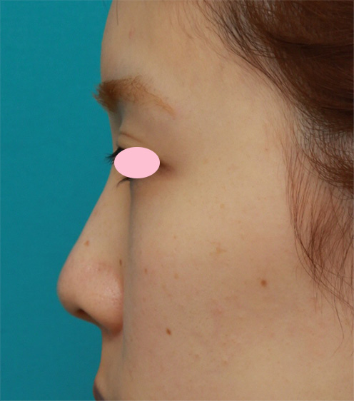 症例写真,耳介軟骨移植で鼻先を斜め下方向に出した症例写真,Before,ba_jikai38_b.jpg