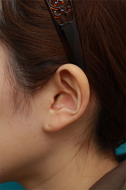 症例写真,耳介軟骨移植で鼻先を斜め下方向に出した症例写真,After（3ヶ月後）,ba_jikai40_b.jpg