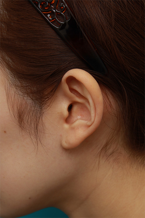 耳介軟骨移植（鼻先を出す）,耳介軟骨移植で鼻先を斜め下方向に出した症例写真,Before,ba_jikai40_b.jpg