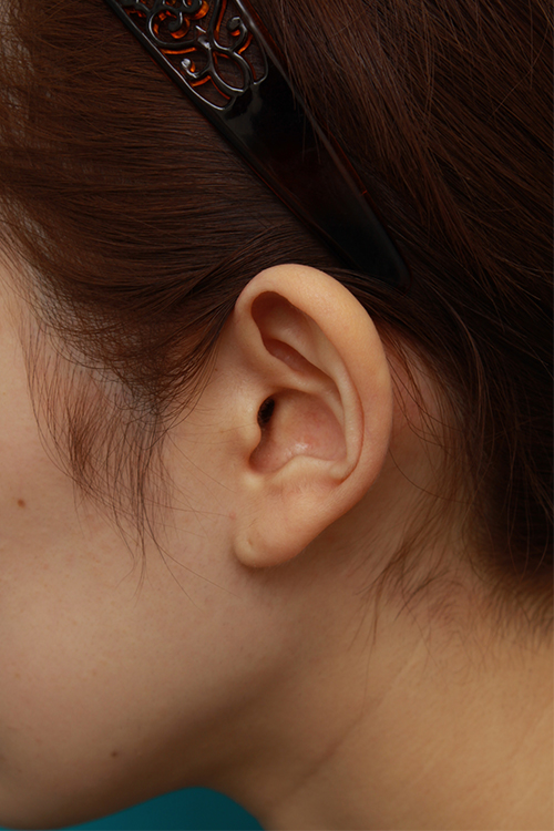 耳介軟骨移植（鼻先を出す）,耳介軟骨移植で鼻先を斜め下方向に出した症例写真,手術前,mainpic_jikai07b.jpg