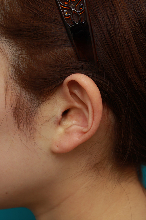 耳介軟骨移植（鼻先を出す）,耳介軟骨移植で鼻先を斜め下方向に出した症例写真,手術直後,mainpic_jikai07d.jpg