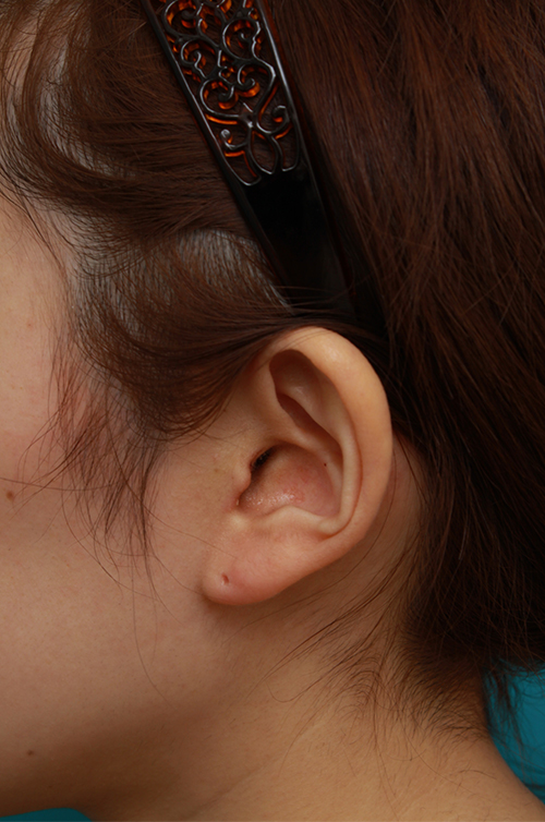 耳介軟骨移植（鼻先を出す）,耳介軟骨移植で鼻先を斜め下方向に出した症例写真,1週間後,mainpic_jikai07f.jpg