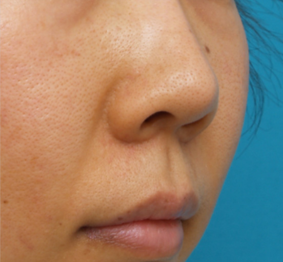 鼻翼縮小（小鼻縮小）の症例写真  強調されてしまう鼻の穴,Before,ba_biyoku13_b.jpg