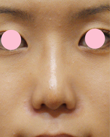 鼻翼縮小（小鼻縮小）の症例写真 小鼻の張り出しを改善,After（1週間後）,ba_biyoku09_a01.jpg