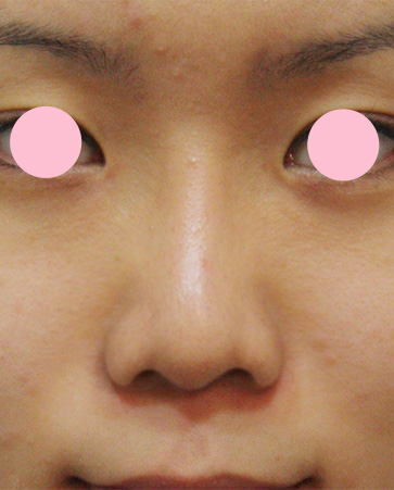 鼻翼縮小（小鼻縮小）の症例写真 小鼻の張り出しを改善,Before,ba_biyoku09_b.jpg