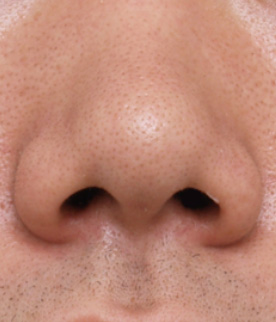 鼻翼縮小（小鼻縮小）の症例写真  鼻の穴が目立つ男性,Before,ba_biyoku15_b.jpg
