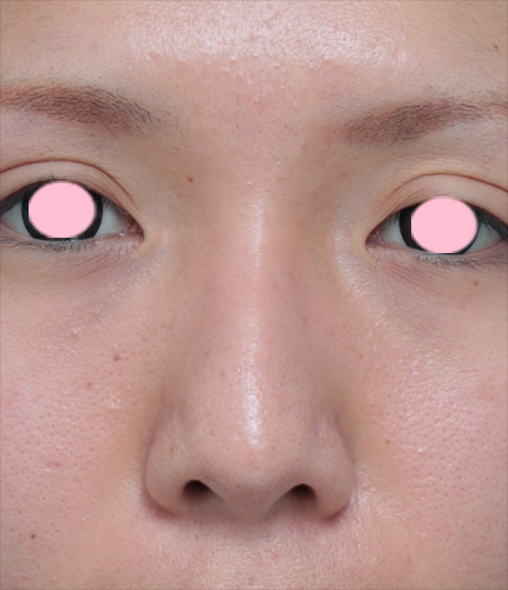 症例写真,鼻翼（小鼻）縮小+鼻のヒアルロン酸注射症例写真,手術前,mainpic_biyoku03a.jpg