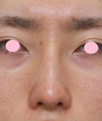 男性の鼻翼（小鼻）縮小症例写真,After（2ヶ月後）,ba_biyoku21_a01.jpg