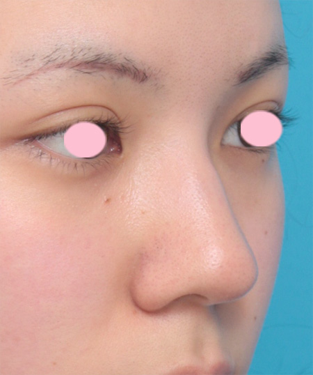 症例写真,鼻尖形成+鼻翼縮小で鼻の下半分を適度に小さくした症例写真,Before,ba_biyoku24_b.jpg