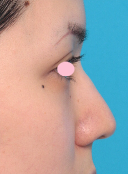 症例写真,鼻尖形成+鼻翼縮小で鼻の下半分を適度に小さくした症例写真,After（3ヶ月後）,ba_biyoku25_b.jpg