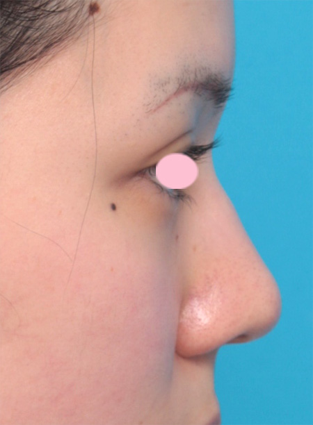 症例写真,鼻尖形成+鼻翼縮小で鼻の下半分を適度に小さくした症例写真,Before,ba_biyoku25_b.jpg
