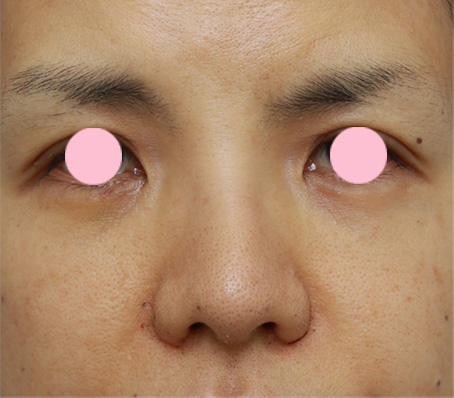 症例写真,鼻翼（小鼻）縮小で、鼻の穴の内側から外側にかけて大きく切開した症例写真,1週間後,mainpic_biyoku05c.jpg