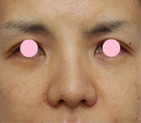 症例写真,鼻翼（小鼻）縮小で、鼻の穴の内側から外側にかけて大きく切開した症例写真,1週間後,mainpic_biyoku05c.jpg