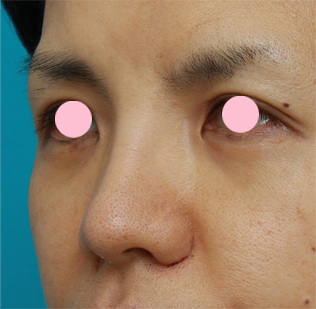 症例写真,鼻翼（小鼻）縮小で、鼻の穴の内側から外側にかけて大きく切開した症例写真,1週間後,mainpic_biyoku05g.jpg