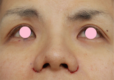 症例写真,鼻翼（小鼻）縮小で、鼻の穴の内側から外側にかけて大きく切開した症例写真,手術直後,mainpic_biyoku05j.jpg