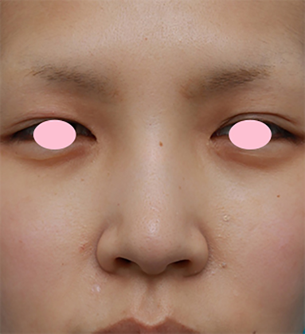 症例写真,鼻翼（小鼻）縮小手術で、自然な範囲内で最大限小鼻を小さくした症例写真,手術前,mainpic_biyoku06a.jpg