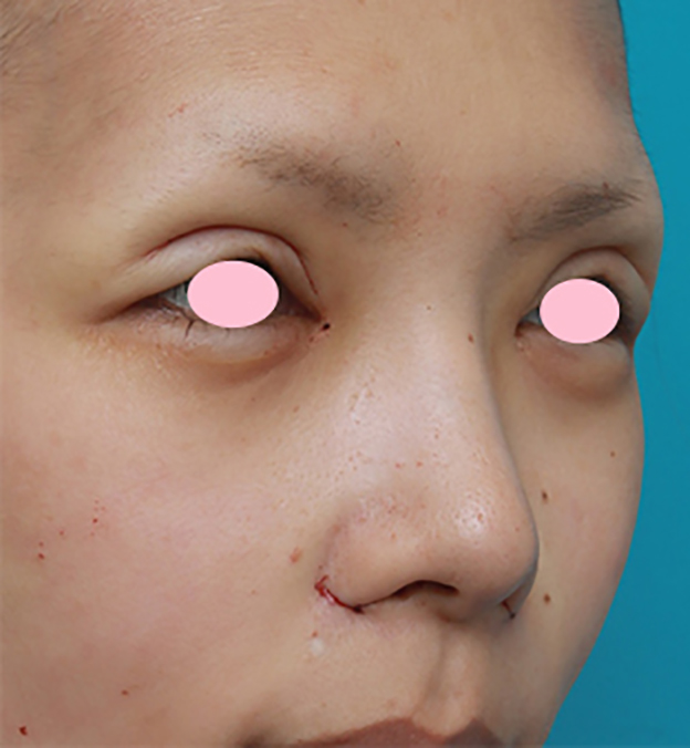 症例写真,鼻翼（小鼻）縮小手術で、自然な範囲内で最大限小鼻を小さくした症例写真,手術直後,mainpic_biyoku06f.jpg
