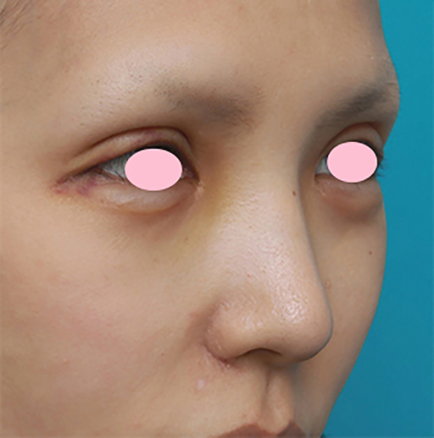 症例写真,鼻翼（小鼻）縮小手術で、自然な範囲内で最大限小鼻を小さくした症例写真,1週間後,mainpic_biyoku06g.jpg
