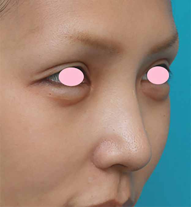症例写真,鼻翼（小鼻）縮小手術で、自然な範囲内で最大限小鼻を小さくした症例写真,3ヶ月後,mainpic_biyoku06h.jpg
