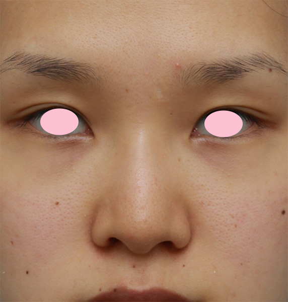症例写真,団子鼻で小鼻が広がっている人に小鼻(鼻翼)縮小手術のみをした症例写真,Before,ba_biyoku31_b.jpg