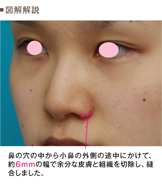 鼻をほじると 鼻の穴が広がって大きくなるのか 小鼻縮小手術後の人や手術していない人に関して Dr 高須幹弥の美容整形講座 美容整形の高須クリニック