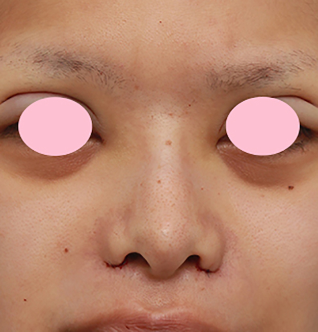 症例写真,小鼻（鼻翼）縮小手術で、横に大きく広がった鼻の穴を小さくした症例写真,手術直後,mainpic_biyoku09b.jpg