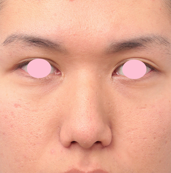 症例写真,小鼻縮小（鼻翼縮小）手術で、正面から見て目立っていた鼻の穴を目立たなくした男性の症例写真の術前術後画像,After（6ヶ月後）,ba_biyoku37_b.jpg