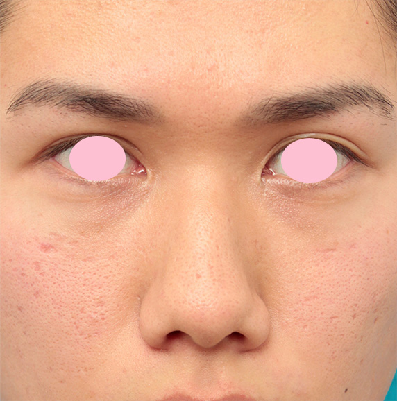 症例写真,小鼻縮小（鼻翼縮小）手術で、正面から見て目立っていた鼻の穴を目立たなくした男性の症例写真の術前術後画像,Before,ba_biyoku37_b.jpg