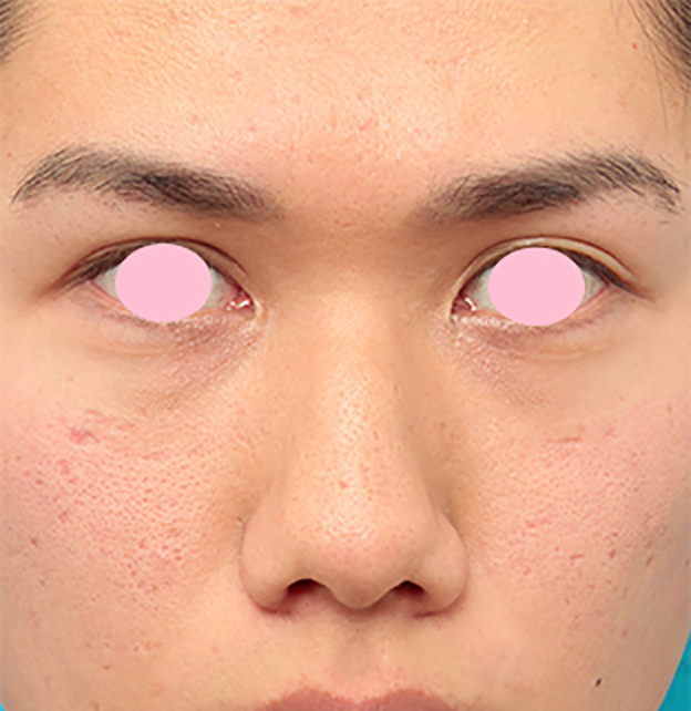 症例写真,小鼻縮小（鼻翼縮小）手術で、正面から見て目立っていた鼻の穴を目立たなくした男性の症例写真の術前術後画像,手術前,mainpic_biyoku10a.jpg