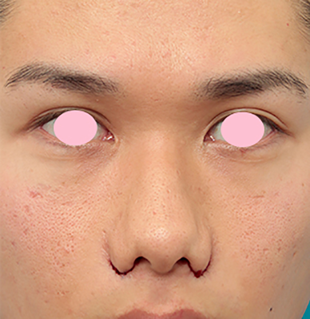 症例写真,小鼻縮小（鼻翼縮小）手術で、正面から見て目立っていた鼻の穴を目立たなくした男性の症例写真の術前術後画像,手術直後,mainpic_biyoku10b.jpg