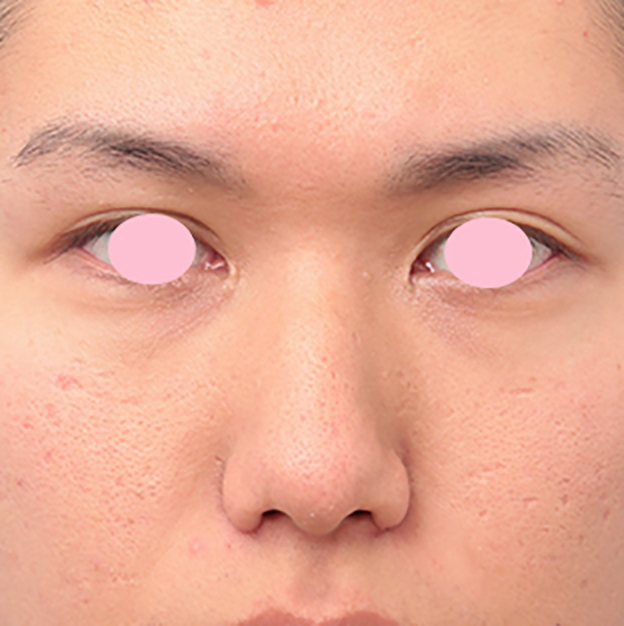 症例写真,小鼻縮小（鼻翼縮小）手術で、正面から見て目立っていた鼻の穴を目立たなくした男性の症例写真の術前術後画像,6ヶ月後,mainpic_biyoku10d.jpg