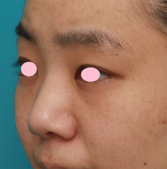 症例写真,鼻尖縮小（鼻尖形成）+小鼻縮小（鼻翼縮小）で大きな鼻を小さくすっきりさせた症例写真の術前術後画像,Before,ba_biyoku39_b.jpg