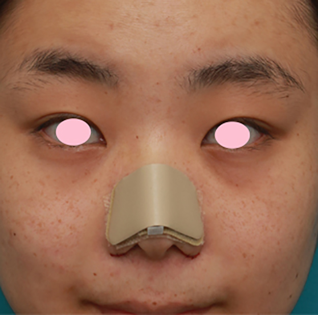 症例写真,鼻尖縮小（鼻尖形成）+小鼻縮小（鼻翼縮小）で大きな鼻を小さくすっきりさせた症例写真の術前術後画像,手術直後,mainpic_biyoku11b.jpg