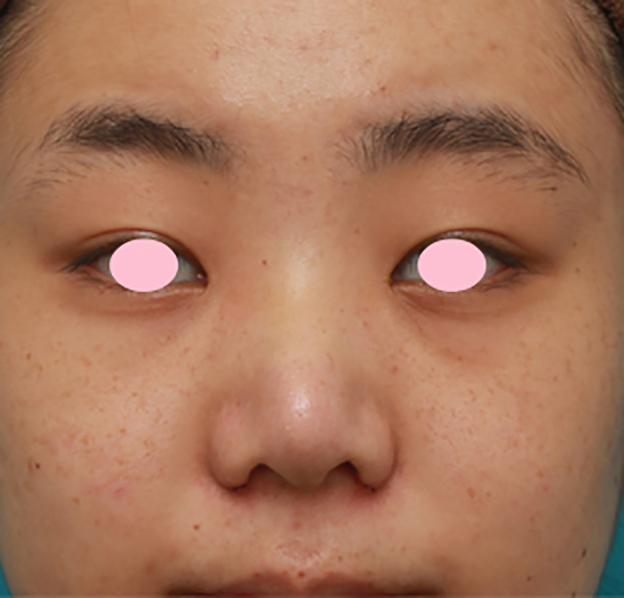 症例写真,鼻尖縮小（鼻尖形成）+小鼻縮小（鼻翼縮小）で大きな鼻を小さくすっきりさせた症例写真の術前術後画像,3日後,mainpic_biyoku11c.jpg