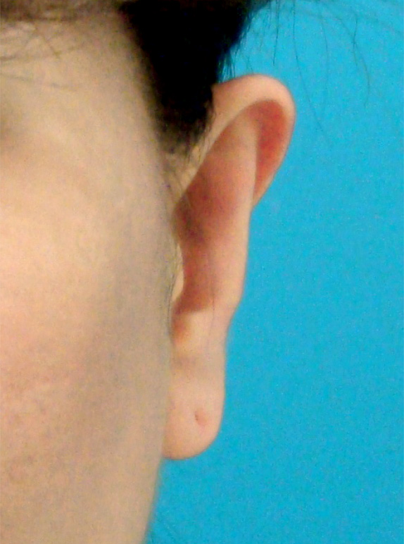 症例写真,立ち耳の症例 いつも耳を隠すような髪型をしていた30代女性,After,ba_tachimimi02_b.jpg