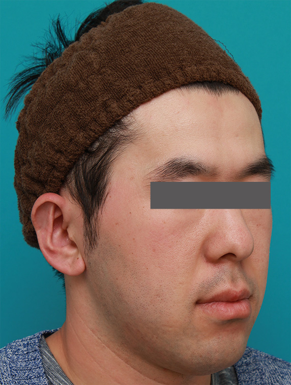 症例写真,立ち耳を修正手術で治した症例写真,After(1ヶ月後),ba_tachimimi03_b02.jpg