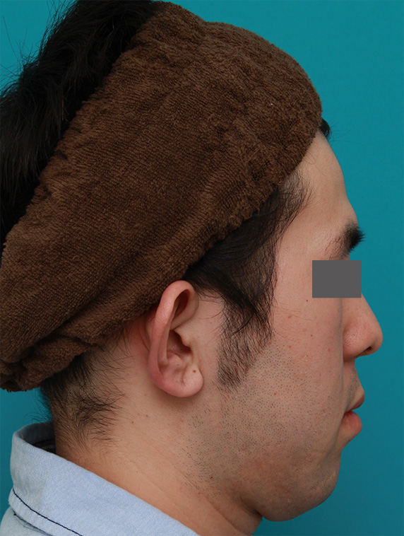 症例写真,立ち耳を修正手術で治した症例写真,Before,ba_tachimimi03_b03.jpg
