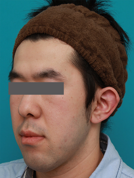 症例写真,立ち耳を修正手術で治した症例写真,Before,ba_tachimimi03_b04.jpg