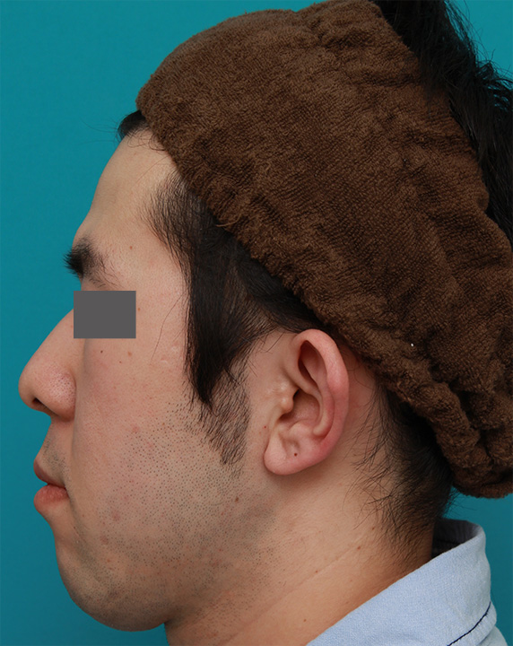 症例写真,立ち耳を修正手術で治した症例写真,Before,ba_tachimimi03_b05.jpg