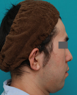 症例写真,立ち耳を修正手術で治した症例写真,1週間後,mainpic_tachimimi03c.jpg