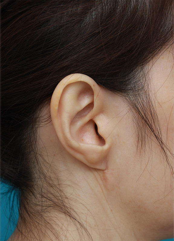 耳たぶのくびれを手術で作った症例写真,After（6ヶ月後）,ba_mimiother08_a01.jpg