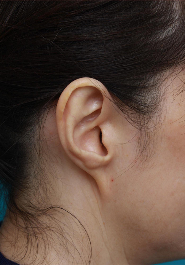 症例写真,耳たぶのくびれを手術で作った症例写真,手術前,mainpic_mimiother04a.jpg