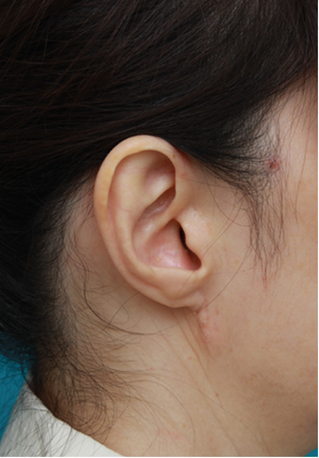 症例写真,耳たぶのくびれを手術で作った症例写真,1ヶ月後,mainpic_mimiother04d.jpg