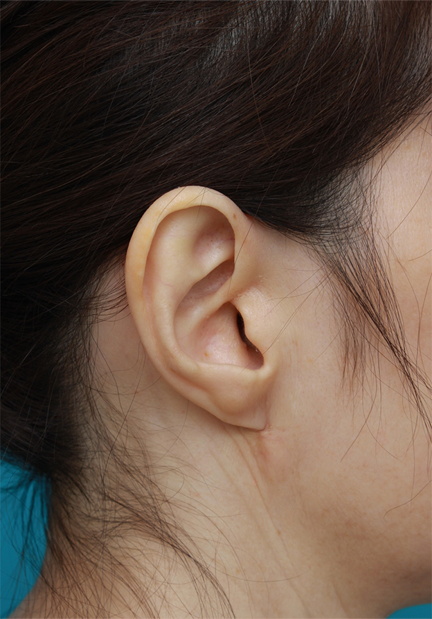 症例写真,耳たぶのくびれを手術で作った症例写真,6ヶ月後,mainpic_mimiother04e.jpg
