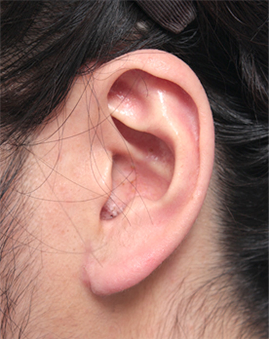 耳たぶの縮小手術の症例写真,After（1週間後）,ba_mimiother06_a01.jpg