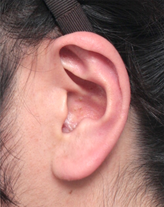 耳たぶの縮小手術の症例写真,Before,ba_mimiother06_b.jpg