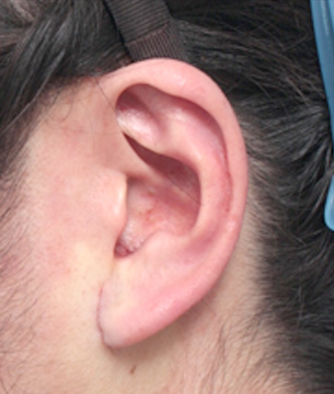 症例写真,耳たぶの縮小手術の症例写真,手術直後,mainpic_mimiother02b.jpg